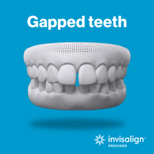 Invisalign for Gapped Teeth