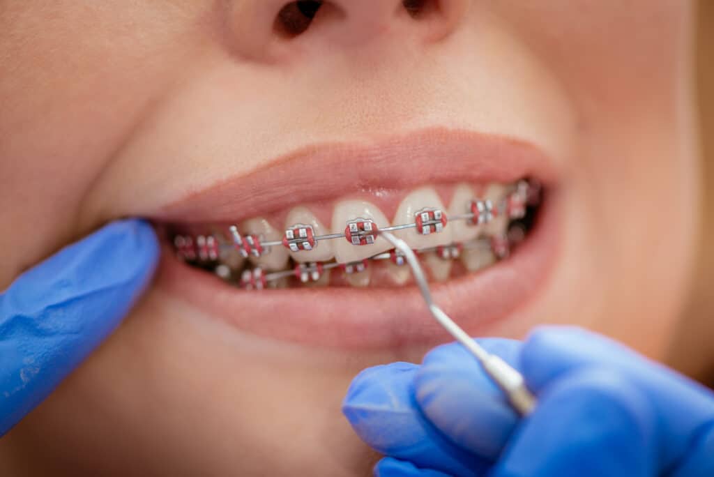 Orthodontist Checking Braces in Patient's Mouth